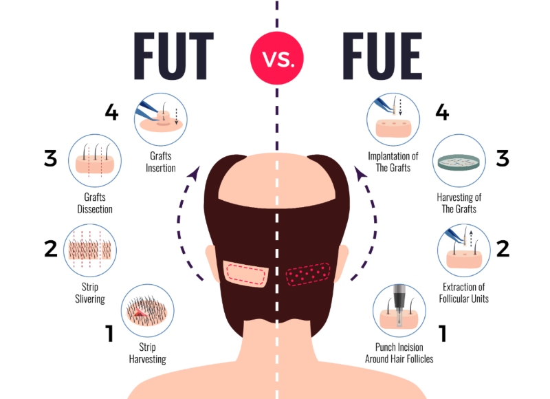 FUT VS FUE